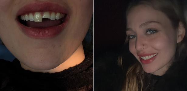 Jovem quebra dente na balada no PR, cola na madrugada e volta para a festa